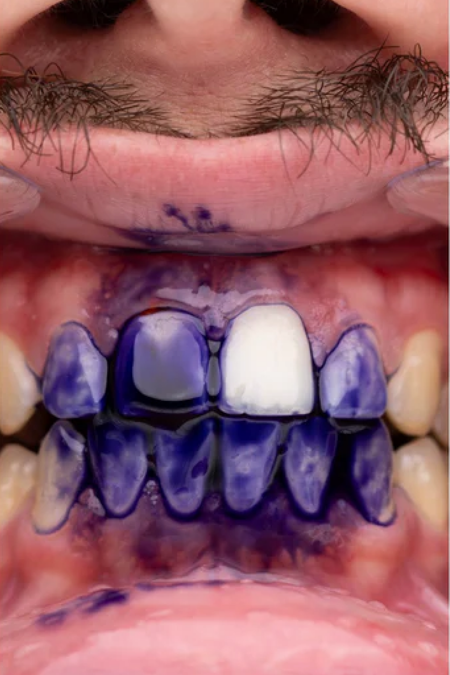 PURPLE V34 – Jūsų švytinčios šypsenos paslaptis