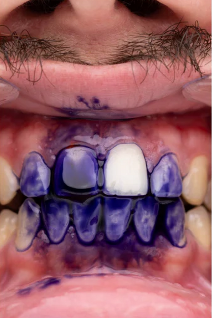 PURPLE V34 – Jūsų švytinčios šypsenos paslaptis